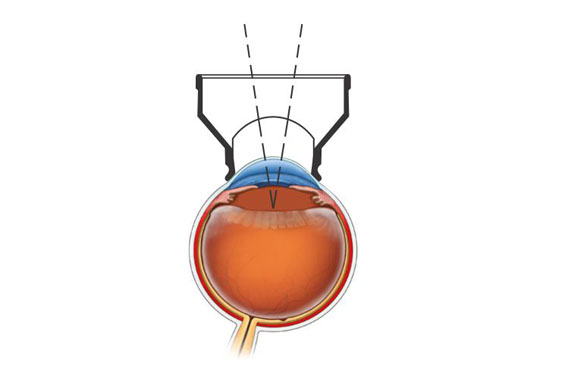 Capsulotomy Lens (for YAG laser)