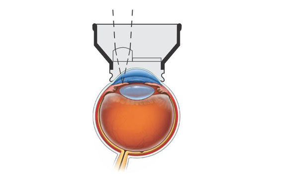 Iridectomy Lens (for YAG laser)